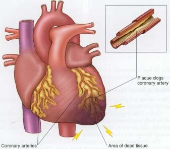 heart_attack